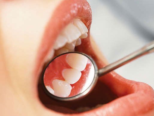 dents
